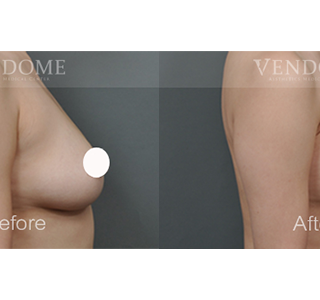 療程效果因人而異，上圖為該案例實際進行果凍矽膠隆乳手術後之成效