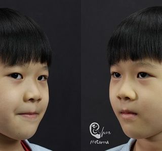 療程效果因人而異，上圖為7歲小朋友實際進行單側(右耳)小耳症手術術後之成效。