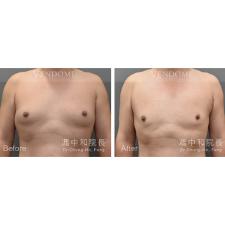 此案例在術前可看到激凸情況明顯，在做完進階男性女乳手術後，胸部已變得平坦