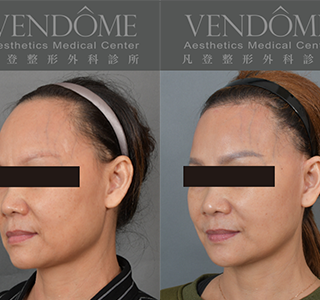 功能性前額拉皮可有效改善髮際線，微調額頭高度，使臉部比例更加好看