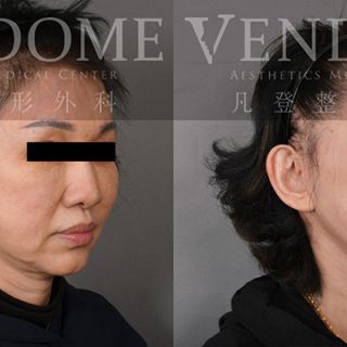 65歲女性 中下臉拉皮合併頸部拉皮合併補脂 解決鬆弛堆疊的下巴皺紋 改善法令紋與木偶紋 膨潤蘋果肌與強化整體中下臉線條