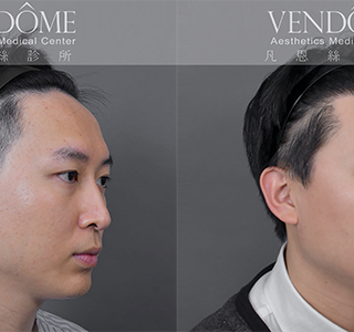 隨著年齡增長，髮際線逐漸上移，讓額頭顯得過於寬大或不均勻。透過植髮手術將髮際線往前調整，重新塑造自然的髮際輪廓，讓整張臉看起來更年輕、有精神。