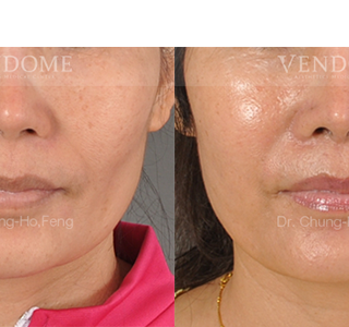 療程效果因人而異，上圖為該案例實際進行自體脂肪填補手術術後之成效