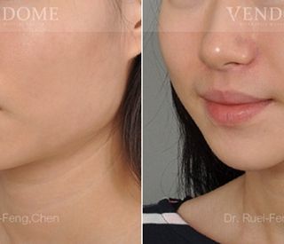 療程效果因人而異，上圖之案例同時將下顎骨角修順＋下巴延長。