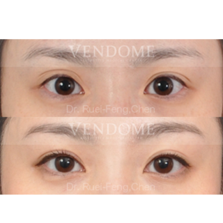 療程效果因人而異，上圖為該案例實際進行縫雙眼皮手術術後之成效