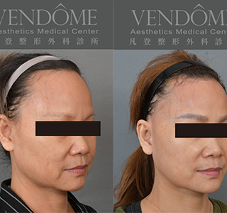 功能性前額拉皮可有效改善髮際線，微調額頭高度，使臉部比例更加好看