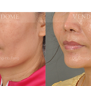 療程效果因人而異，上圖為該案例實際進行自體脂肪填補手術術後之成效