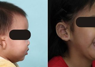 療程效果因人而異，上圖為實際進行小耳症手術（人工材質Medpor）術後之成效。