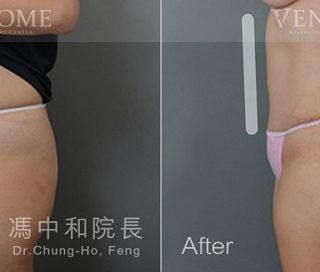 利用鑽石形腹部拉皮，除了幫X小姐改善了鬆垮的肚皮以外，也特地針對她鼠蹊部兩側的皮膚下墜一併做了提拉，可以發現她的腹部不僅變得平坦了，肚臍的形狀也在手術中一併改善，從一字型變回小巧橢圓形，手術疤痕也設計在內褲、褲子能夠剛好遮住的完美位置！