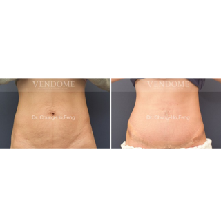療程效果因人而異，上圖為該案例實際進行腹拉、腹部拉皮手術術後成效