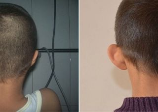 療程效果因人而異，上圖為實際進行小耳症手術（人工材質Medpor）術後之成效。