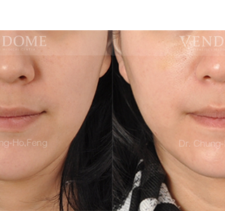 療程效果因人而異，上圖為該案例實際進行自體脂肪填補手術術後之成效