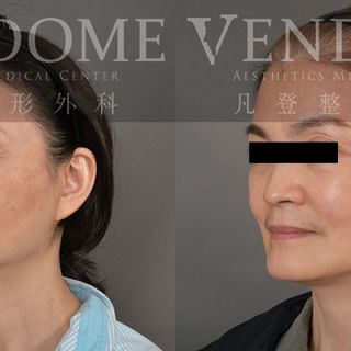 54歲女性 中下臉與頸部拉皮 淡化法令紋 膨潤蘋果肌 改善臉部細紋 增加整體面部光澤感