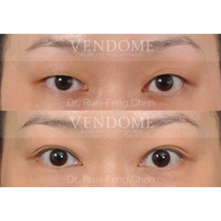 療程效果因人而異，上圖為該案例實際進行縫雙眼皮手術術後之成效