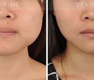 療程效果因人而異，上圖之案例是把比較大的下顎骨角移除。