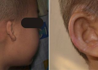 療程效果因人而異，上圖為實際進行小耳症手術（人工材質Medpor）術後之成效。