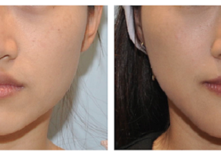 療程效果因人而異，上圖之案例同時將下顎骨角修順＋下巴延長，臉型從原先方短寬變得小而精緻，並透過下巴手術擁有更理想的臉部比例。