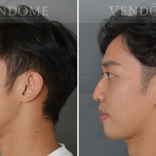 療程效果因人而異，上圖為下巴後縮合併顏面歪斜案例實際進行正顎手術術後之成效。