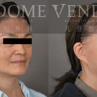 54歲女性 中下臉與頸部拉皮 淡化法令紋 膨潤蘋果肌 改善臉部細紋 增加整體面部光澤感