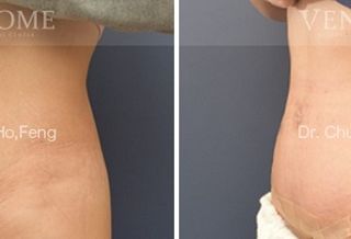 療程效果因人而異，上圖為該案例實際進行腹拉、腹部拉皮手術術後成效