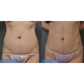 療程效果因人而異，上圖為該案例實際進行腹拉、腹部拉皮手術術後成效