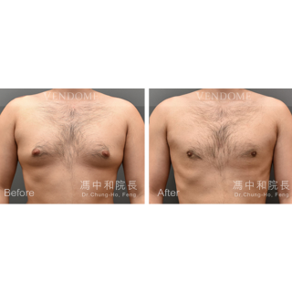 此案例在術前可看到激凸情況明顯，在做完進階男性女乳手術後，胸部已變得平坦