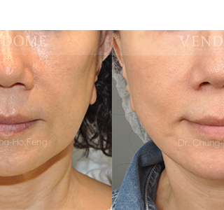 療程效果因人而異，上圖為該案例實際進行自體脂肪填補手術術後之成效