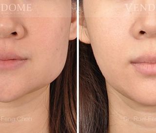 療程效果因人而異，上圖之案例是在接受正顎手術的同時，將下顎骨角做適當的修飾，把比較大的下顎骨角移除。