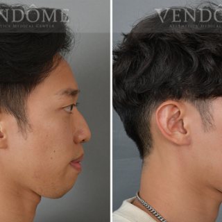 療程效果因人而異，上圖為下巴後縮合併顏面歪斜案例實際進行正顎手術術後之成效。