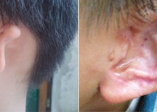 療程效果因人而異，上圖為實際進行小耳症手術（人工材質Medpor）術後之成效。