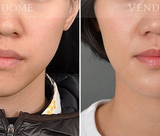 療程效果因人而異，上圖為戽斗合併顏面歪斜案例實際進行正顎手術術後之成效。