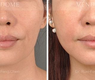 療程效果因人而異，上圖之案例是在接受正顎手術的同時，將下顎骨角做適當的修飾，把比較大的下顎骨角移除，同時改善左右臉不對稱問題。