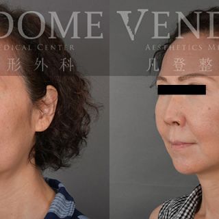 60歲女性 中下臉拉皮合併補脂 增加兩頰膨潤感 淡化法令紋 完美改善木偶紋