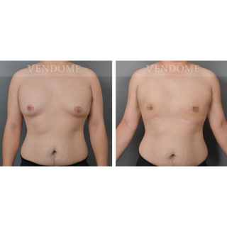 術前女乳形狀明顯，乳房外側凸出，術後變得平坦，外側線條也變得平順