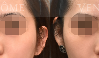 療程效果因人而異，上圖為該案例實際進行隆鼻手術術後之成效