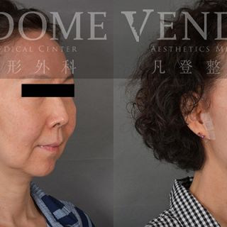 60歲女性 中下臉拉皮合併補脂 增加兩頰膨潤感 淡化法令紋 完美改善木偶紋