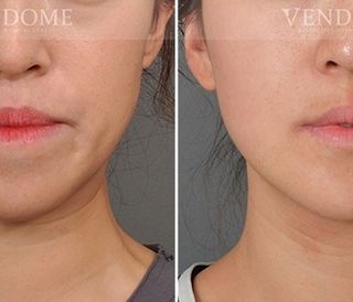 療程效果因人而異，上圖為戽斗合併顏面歪斜案例實際進行正顎手術術後之成效。