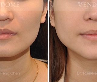 療程效果因人而異，上圖之案例是在接受正顎手術的同時，將下顎骨角做適當的修飾，打造較柔順的下顎線，使整體臉部視覺看起來更小。