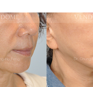 療程效果因人而異，上圖為該案例實際進行自體脂肪填補手術術後之成效