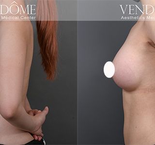 術前 B cup -> 術後 E cup 原本的下胸部比例上較小，珍珠波隆乳後， 順著原本地上胸打造完美水滴型。 療程效果因人而異，上圖為該案例實際進行果凍矽膠隆乳手術後之成效