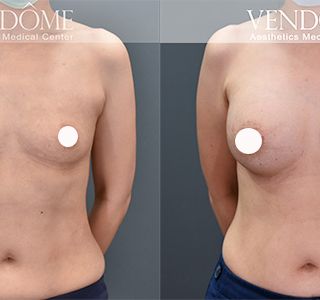 術前 B cup -> 術後 E cup 原乳房小而下垂，經過女王波隆乳後，整體胸型更渾圓、挺立。 療程效果因人而異，上圖為該案例實際進行果凍矽膠隆乳手術後之成效