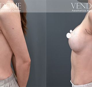 術前 A cup -> 術後 E cup 原本平胸的案例，接受魔滴隆乳後，沿原本胸廓，打造大而飽滿的胸部，日常穿衣或泳衣搭配更有自信。 療程效果因人而異，上圖為該案例實際進行果凍矽膠隆乳手術後之成效