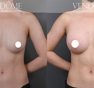 術前 B cup -> 術後 E cup 原本的下胸部比例上較小，珍珠波隆乳後， 順著原本地上胸打造完美水滴型。 療程效果因人而異，上圖為該案例實際進行果凍矽膠隆乳手術後之成效