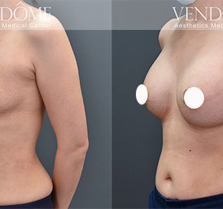 術前 B cup -> 術後 E cup 原乳房小而下垂，經過女王波隆乳後，整體胸型更渾圓、挺立。 療程效果因人而異，上圖為該案例實際進行果凍矽膠隆乳手術後之成效