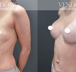 術前 A cup -> 術後 E cup 原本平胸的案例，接受魔滴隆乳後，沿原本胸廓，打造大而飽滿的胸部，日常穿衣或泳衣搭配更有自信。 療程效果因人而異，上圖為該案例實際進行果凍矽膠隆乳手術後之成效