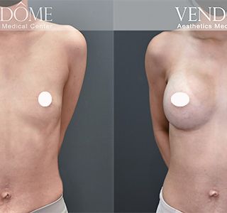 術前 A cup -> 術後 E cup 原本平胸的案例，接受魔滴隆乳後，沿原本胸廓，打造大而飽滿的胸部，日常穿衣或泳衣搭配更有自信。 療程效果因人而異，上圖為該案例實際進行果凍矽膠隆乳手術後之成效