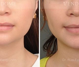 療程效果因人而異，上圖為該案例實際術後成效