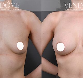 術前 B cup -> 術後 E cup 案例大量減重後，透過珍珠波隆乳解決下垂乳房，達到理想的胸部與身形比例。 療程效果因人而異，上圖為該案例實際進行果凍矽膠隆乳手術後之成效