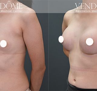 術前 A cup -> 術後 E cup 原本平胸的案例，接受女王波隆乳後，沿原本胸廓，打造大而飽滿的美胸。 療程效果因人而異，上圖為該案例實際進行果凍矽膠隆乳手術後之成效