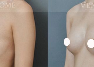 術前 A cup -> 術後 D cup 原本整體胸部較小，胸型也不好看，在接受魔滴隆乳後， 胸型較大與挺，塑造出乳溝，胸側輪廓也較飽滿。 療程效果因人而異，上圖為該案例實際進行果凍矽膠隆乳手術後之成效